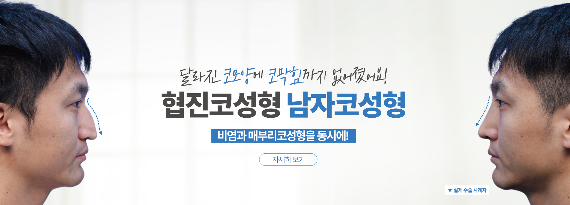 협진코성형 남자코성형