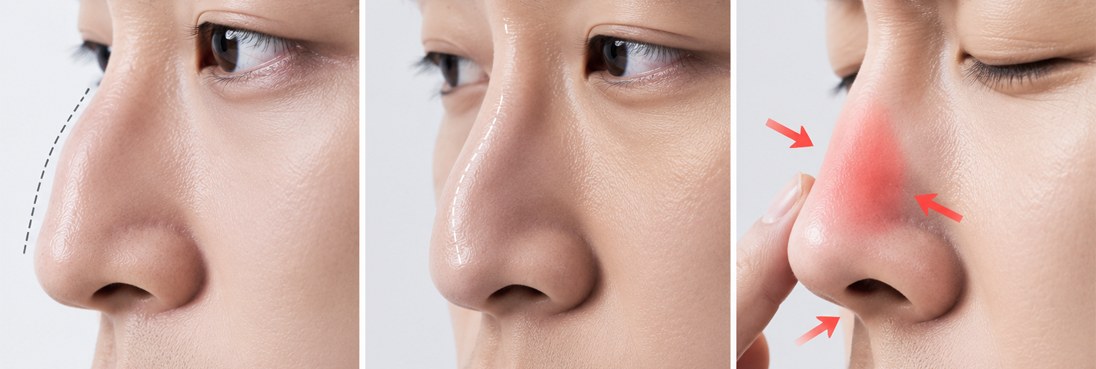 코뼈골절 방치 시 나타날 수 있는 매부리코·휜코·비중격만곡증 변형 예시